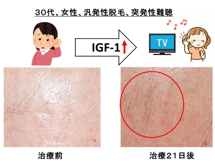 突発性難聴　治る